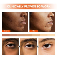 HKM-784403 4-in-1 Kojic Acid Face Serum with Niacinamide, Arbutin, Vitamin C, and Squalane for Dark Spot Correction