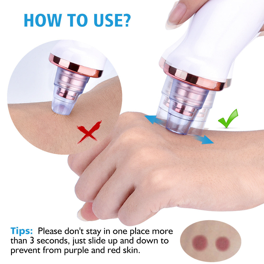 HKM-677971 Electric Blackhead Remover with 5 Suction Heads, Acne Treatment & Skin Rejuvenation Device