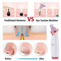 HKM-677971 Electric Blackhead Remover with 5 Suction Heads, Acne Treatment & Skin Rejuvenation Device