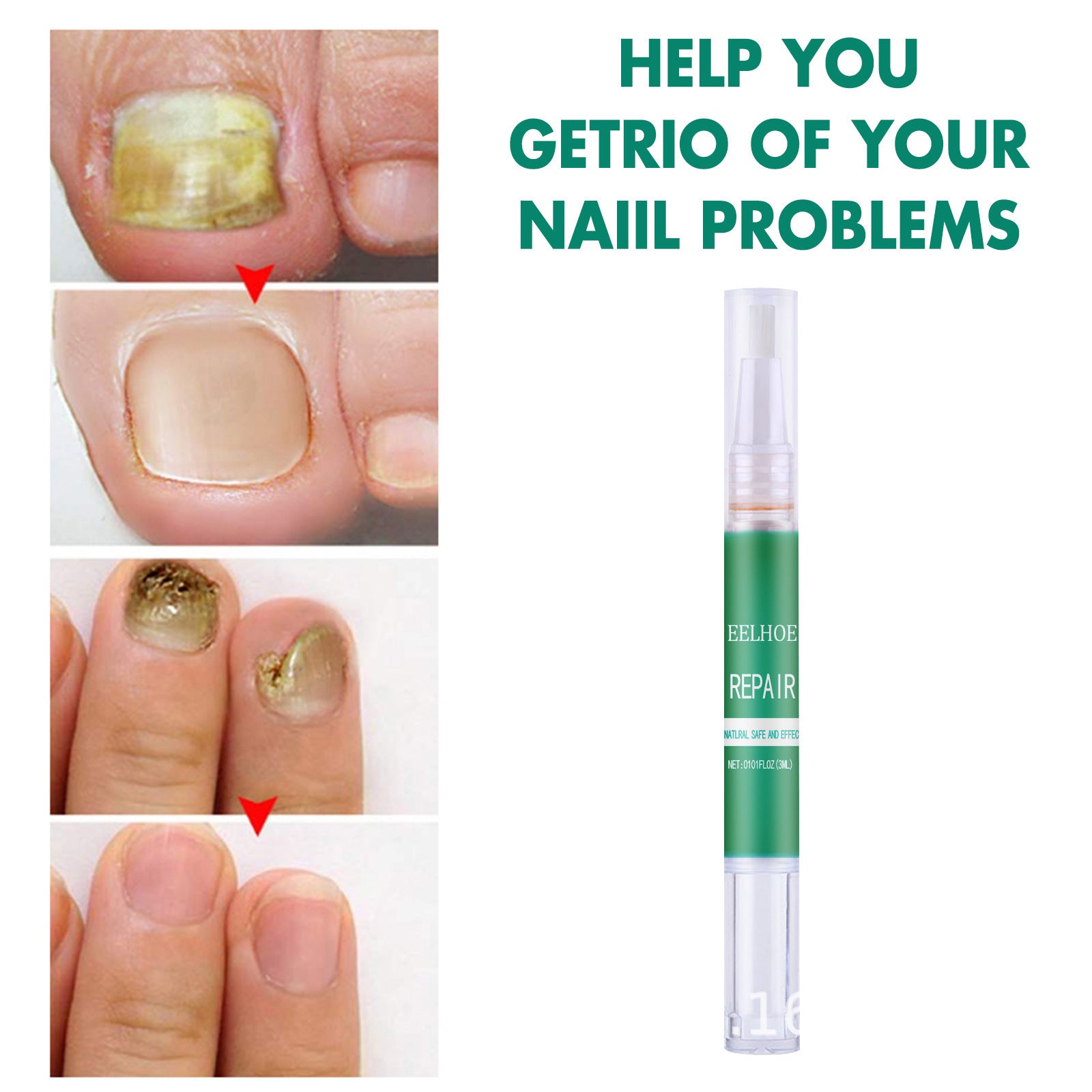 JMT-417482 Onychomycosis Nail Repair Nutrition Pen for Yellow Nails - 22g