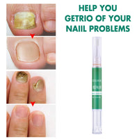 HKM-556179 Onychomycosis Nail Repair Nutrition Pen for Yellow Nails - 22g