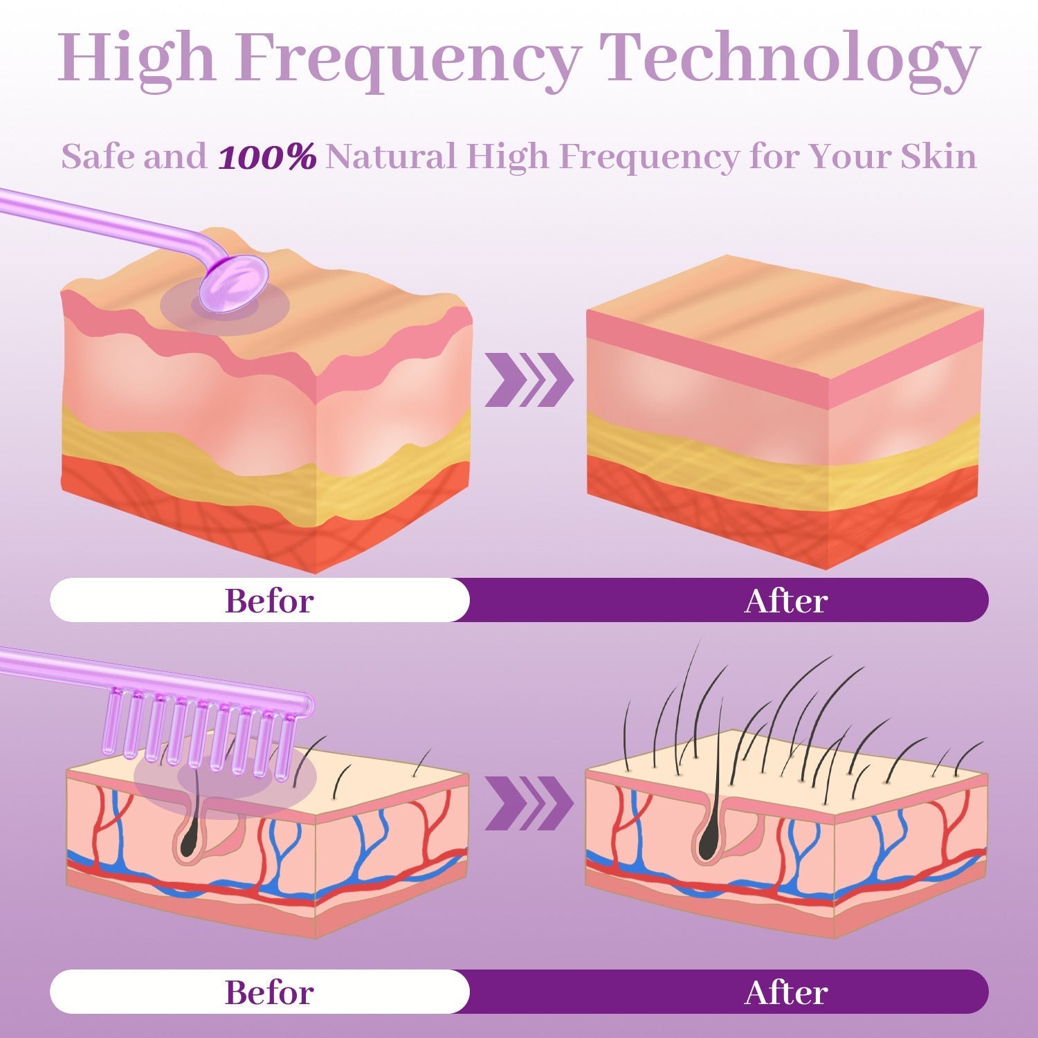 HKM-626259 High Wave Electrotherapy Rod Set for Wrinkle Removal and Skin Rejuvenation
