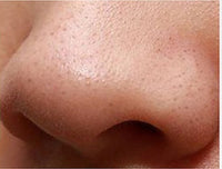 HKM-054547 Intelligent Blackhead Removal Device with Hot and Cold Cupping Feature