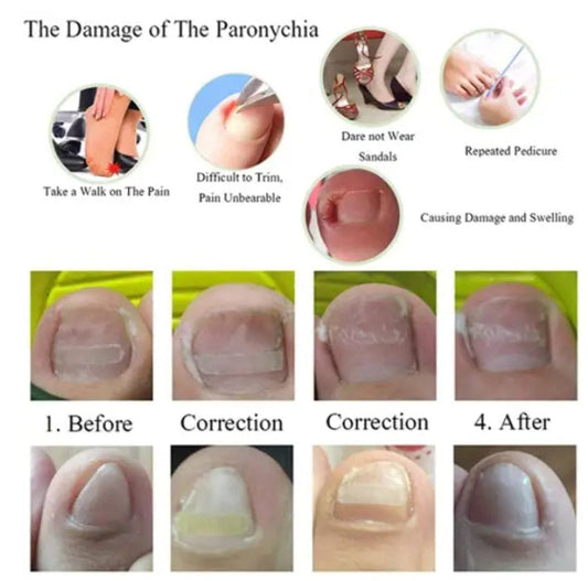 HKM-629779 Ingrown Toenail Correction Patch for Healthy Nail Growth and Pain Relief