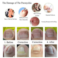 HKM-629779 Ingrown Toenail Correction Patch for Healthy Nail Growth and Pain Relief