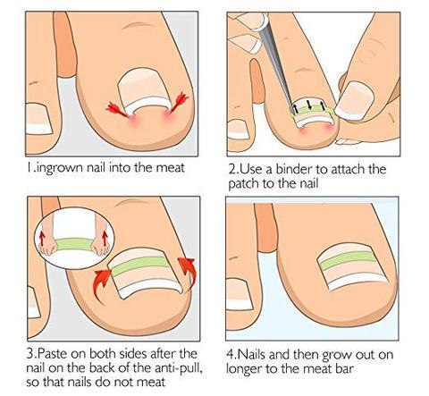 HKM-629779 Ingrown Toenail Correction Patch for Healthy Nail Growth and Pain Relief