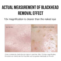 HKM-557267 Effective Blackhead Remover with Adjustable Suction Speed and Built-in LED Light