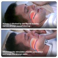 HKM-219859 Smart Anti-Snoring Device with Electronic Muscle Stimulation Technology